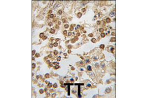 Formalin-fixed and paraffin-embedded human testis tissue reacted with DPPA4 polyclonal antibody  , which was peroxidase-conjugated to the secondary antibody, followed by DAB staining. (DPPA4 anticorps  (N-Term))