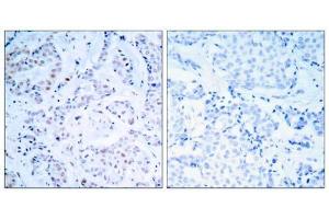 Immunohistochemical analysis of paraffin-embedded human breast carcinoma tissue using Estrogen Receptor-α (Ab-104) antibody (E021065). (Estrogen Receptor alpha anticorps)