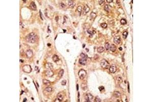IHC analysis of FFPE human hepatocarcinoma tissue stained with the TLR5 antibody