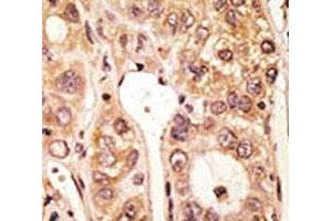 IHC analysis of FFPE human hepatocarcinoma tissue stained with the TLR5 antibody (TLR5 anticorps  (AA 825-856))