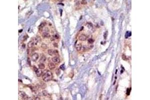 IHC analysis of FFPE human breast carcinoma tissue stained with the FYN antibody