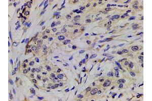 ABIN6267452 at 1/200 staining human esophageal carcinoma tissue sections by IHC-P.