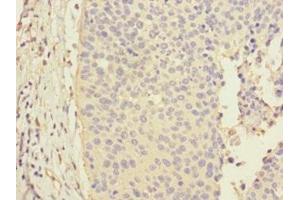 Immunohistochemistry of paraffin-embedded human cervical cancer using ABIN7146495 at dilution of 1:100 (CALML3 anticorps  (AA 1-149))