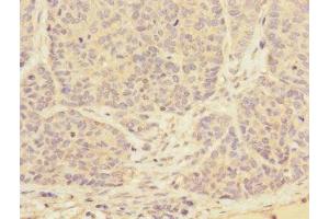 Immunohistochemistry of paraffin-embedded human ovarian cancer using ABIN7173562 at dilution of 1:100 (Tropomyosin 4 anticorps  (AA 1-248))