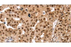 Immunohistochemistry of paraffin-embedded Human breast cancer using SMARCB1 Polyclonal Antibody at dilution of 1:30 (SMARCB1 anticorps)