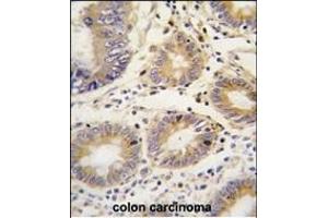 Formalin-fixed and paraffin-embedded human colon carcinoma tissue reacted with LEFTB antibody (C-term)  , which was peroxidase-conjugated to the secondary antibody, followed by DAB staining. (LEFTY1 anticorps  (C-Term))