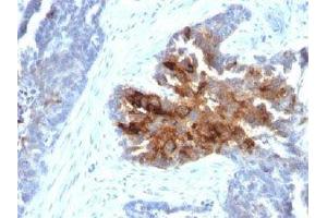 IHC staining of human ovarian carcinoma with TAG-72 antibody cocktail (B72. (TAG-72 anticorps)