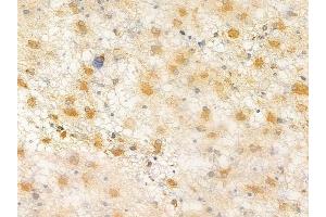 ABIN6264705 and ABIN6266630 at 1/100 staining human astrocytoma by IHC-P. (Retinoic Acid Receptor beta anticorps  (Internal Region))