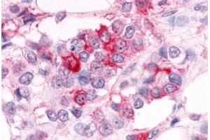 Anti-ESRRA antibody  ABIN1048581 IHC staining of human breast carcinoma.