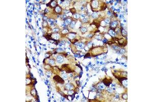 Immunohistochemistry of paraffin-embedded Human breast cancer using  Rabbit pAb (ABIN7265743) at dilution of 1:100 (40x lens). (ABCF3 anticorps  (AA 1-200))