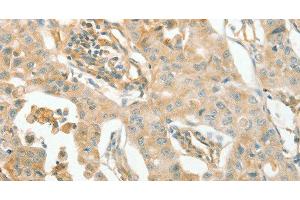 Immunohistochemistry of paraffin-embedded Human lung cancer using ACE1 Polyclonal Antibody at dilution of 1:70 (Angiotensin I Converting Enzyme 1 anticorps)