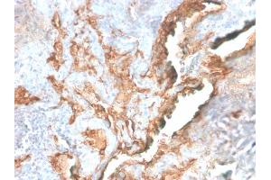 Formalin-fixed, paraffin-embedded human Lung Carcinoma stained with Tenascin C Rabbit Recombinant Monoclonal Antibody (TNC/2981R).
