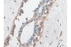 Detection of EZR in Human Breast cancer Tissue using Polyclonal Antibody to Ezrin (EZR)