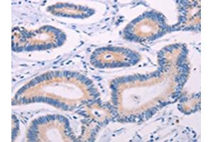 The image on the left is immunohistochemistry of paraffin-embedded Human colon cancer tissue using ABIN7131322(TEKT4 Antibody) at dilution 1/20, on the right is treated with fusion protein. (Tektin 4 anticorps)
