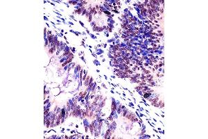 (ABIN6242416 and ABIN6578503) staining KHDRBS1 in human colorectal carcinoma tissue sections by Immunohistochemistry (IHC-P - paraformaldehyde-fixed, paraffin-embedded sections).