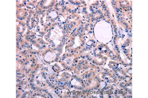 Immunohistochemistry of Human thyroid cancer using LEP Polyclonal Antibody at dilution of 1:30 (Leptin anticorps)