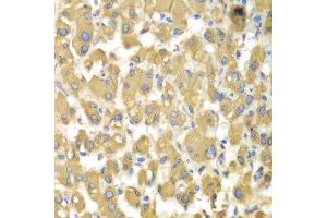 Immunohistochemistry of paraffin-embedded human liver injury using MAP4K3 antibody at dilution of 1:100 (x400 lens). (MAP4K3 anticorps)