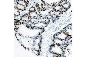 Immunohistochemical analysis of Rpb1 CTD staining in human colon cancer formalin fixed paraffin embedded tissue section. (Rpb1 CTD anticorps  (C-Term))
