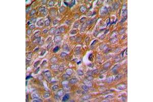 Immunohistochemical analysis of Calnexin (pS583) staining in human breast cancer formalin fixed paraffin embedded tissue section. (Calnexin anticorps  (C-Term, pSer583))