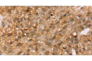 Immunohistochemistry of paraffin-embedded Human breast cancer tissue using MED22 Polyclonal Antibody at dilution 1:50 (MED22 anticorps)
