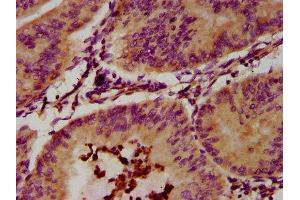 IHC image of ABIN7151818 diluted at 1:300 and staining in paraffin-embedded human endometrial cancer performed on a Leica BondTM system.