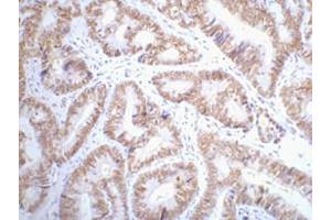IHC-P staining of Human colon cancer tissue paraffin-embedded, diluted at 1:200. (p53 anticorps)
