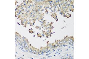 Immunohistochemistry of paraffin-embedded human prostate using NEDD4L antibody at dilution of 1:200 (40x lens). (NEDD4-2 anticorps)