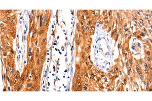 Immunohistochemistry of paraffin-embedded Human esophagus cancer tissue using FBLN1 Polyclonal Antibody at dilution 1:47 (Fibulin 1 anticorps)