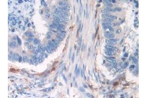 Detection of IFI30 in Human Colorectal cancer Tissue using Polyclonal Antibody to Interferon Gamma Inducible Protein 30 (IFI30)