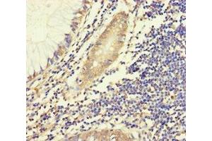 Immunohistochemistry of paraffin-embedded human colon cancer using ABIN7155943 at dilution of 1:100 (Chromosome X Open Reading Frame 27 (CXORF27) (AA 1-117) anticorps)