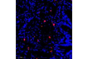 Immunofluorescence of paraffin embedded human lung cancer using CST9L (ABIN7073650) at dilution of 1:900 (300x lens) (CST9L anticorps)
