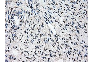 Immunohistochemical staining of paraffin-embedded Adenocarcinoma of breast tissue using anti-PSMD10 mouse monoclonal antibody. (PSMD10 anticorps)