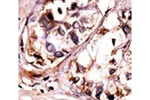 IHC analysis of FFPE human hepatocarcinoma tissue stained with the phospho-Syk antibody.