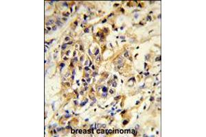 Formalin-fixed and paraffin-embedded human breast carcinoma reacted with RPGRIP1 Antibody , which was peroxidase-conjugated to the secondary antibody, followed by DAB staining. (RPGRIP1 anticorps  (AA 530-557))