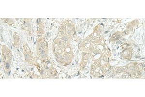 Immunohistochemistry of paraffin-embedded Human breast cancer tissue using MIEN1 Polyclonal Antibody at dilution of 1:45(x200) (C17orf37 anticorps)