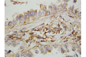 Immunohistochemical staining of paraffin-embedded human lung cancer tissue section with CXCL9 polyclonal antibody . (CXCL9 anticorps  (N-Term))