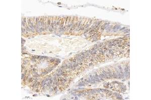Immunohistochemistry of paraffin embedded human colon cancer using ATP1A1 (ABIN7073154) at dilution of 1: 500 (400x lens) (ATPase (Na/K) anticorps)