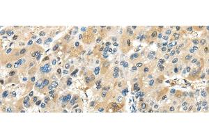 Immunohistochemistry of paraffin-embedded Human liver cancer tissue using TRAIP Polyclonal Antibody at dilution 1:40 (TRAIP anticorps)