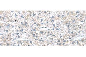 Immunohistochemistry of paraffin-embedded Human liver cancer tissue using CACNB1 Polyclonal Antibody at dilution of 1:110(x200) (CACNB1 anticorps)