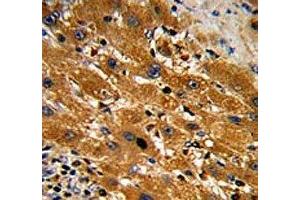 IHC analysis of FFPE human hepatocarcinoma with Caspase-9 antibody