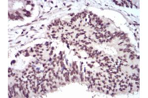 Immunohistochemical analysis of paraffin-embedded rectum cancer tissues using WTAP mouse mAb with DAB staining.