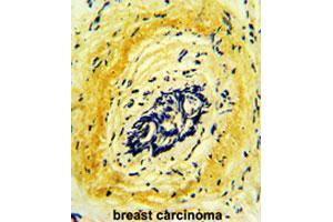 Formalin-fixed and paraffin-embedded human breast carcinomareacted with HTRA1 polyclonal antibody , which was peroxidase-conjugated to the secondary antibody, followed by AEC staining. (HTRA1 anticorps  (AA 124-153))