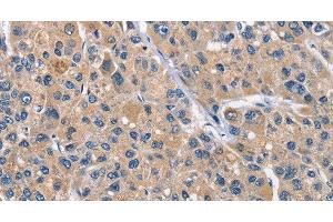 Immunohistochemistry of paraffin-embedded Human liver cancer tissue using CLEC2D Polyclonal Antibody at dilution 1:70 (CLEC2D anticorps)