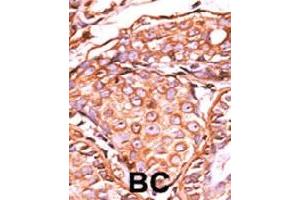 Formalin-fixed and paraffin-embedded human cancer tissue reacted with JUN (phospho S63) polyclonal antibody  which was peroxidase-conjugated to the secondary antibody followed by AEC staining.