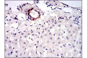 Immunohistochemical analysis of paraffin-embedded liver cancer tissues using MCAM mouse mAb with DAB staining. (MCAM anticorps  (AA 84-189))