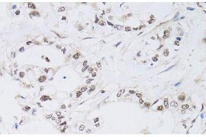 Immunohistochemistry of paraffin-embedded Human gastric cancer using PAX3 Polyclonal Antibody at dilution of 1:100 (40x lens). (Paired Box 3 anticorps)