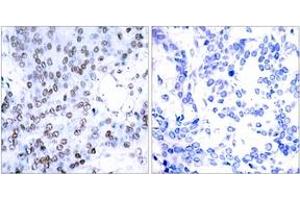 Immunohistochemistry analysis of paraffin-embedded human breast carcinoma tissue, using JunB (Ab-79) Antibody.