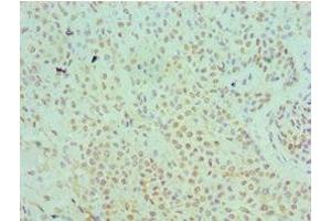 Immunohistochemistry of paraffin-embedded human breast cancer using ABIN7169345 at dilution of 1:100 (SERPINB5 anticorps  (AA 21-189))
