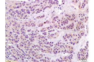 Formalin-fixed and paraffin embedded human endometrial carcinoma labeled with Anti-Notch1/MOTC Polyclonal Antibody, Unconjugated  at 1:200 followed by conjugation to the secondary antibody and DAB staining (Notch1 anticorps  (AA 2101-2300))