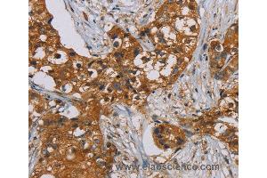 Immunohistochemistry of Human breast cancer using PSMC2 Polyclonal Antibody at dilution of 1:25
